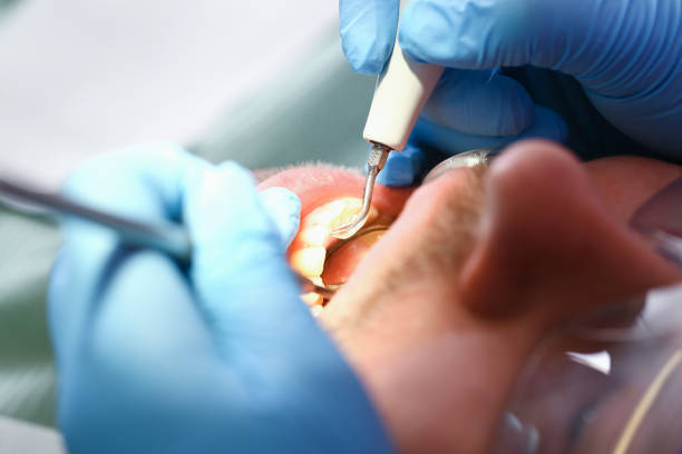 Best Urgent Care for Lost Fillings or Crowns in St Clair, PA